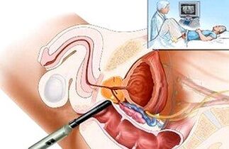Sposoby zdiagnozowania zapalenia prostaty