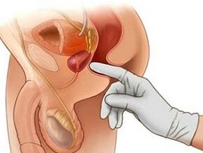 Masaż prostaty w leczeniu zapalenia gruczołu krokowego u mężczyzn