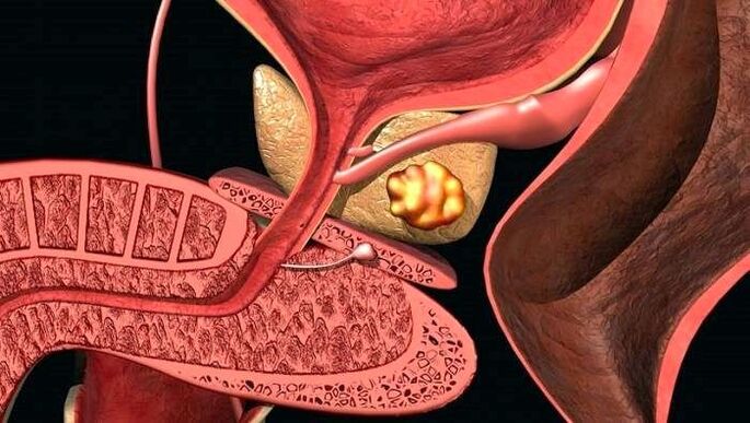 Złogi kamienia w prostacie z kamienistym zapaleniem gruczołu krokowego