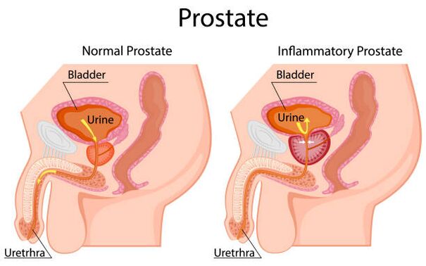 zdrowa prostata ze stanem zapalnym
