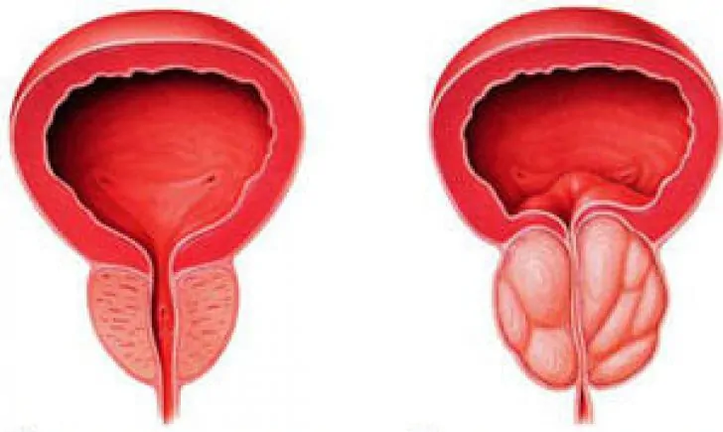 Normalna prostata (po lewej) i przewlekłe zapalenie gruczołu krokowego (po prawej)
