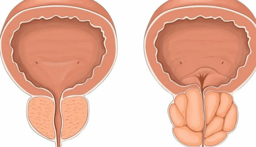 prostata zdrowa i chora